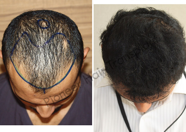 Direct Hair Implantation in Bangalore