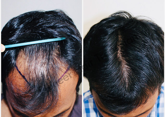 Fut hair transplant in Bangalore