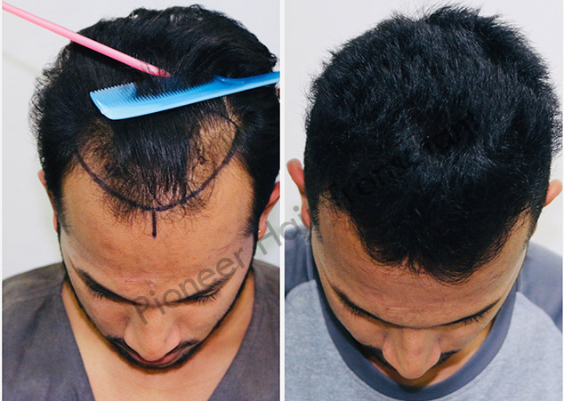 Hair Transplant Clinic in Bangalore